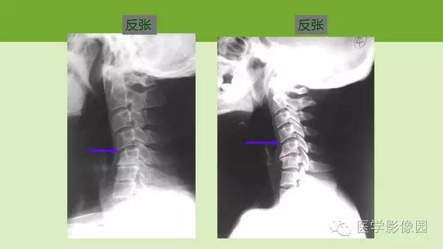 【PPT】颈椎影像阅片方法