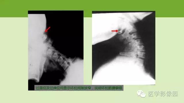 【PPT】颈椎影像阅片方法