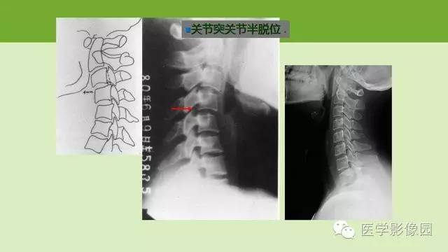 【PPT】颈椎影像阅片方法