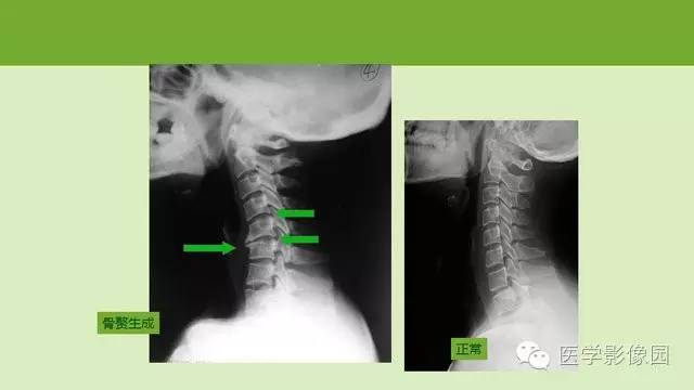 【PPT】颈椎影像阅片方法