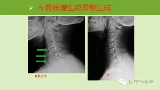 【PPT】颈椎影像阅片方法