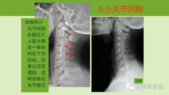 【PPT】颈椎影像阅片方法