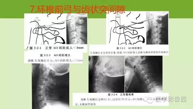 【PPT】颈椎影像阅片方法