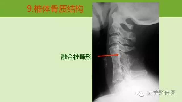 【PPT】颈椎影像阅片方法