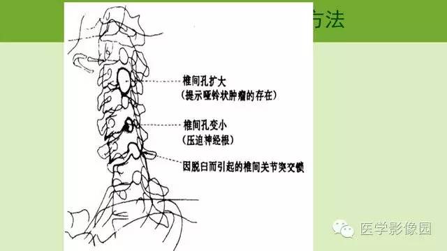 【PPT】颈椎影像阅片方法