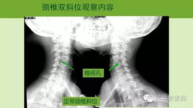 【PPT】颈椎影像阅片方法