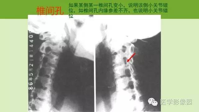 【PPT】颈椎影像阅片方法