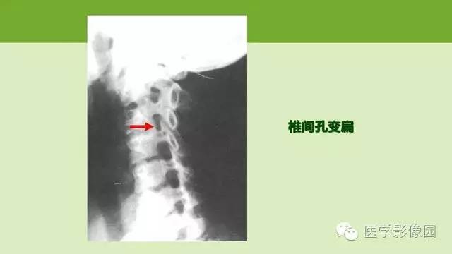 【PPT】颈椎影像阅片方法