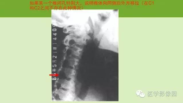 【PPT】颈椎影像阅片方法