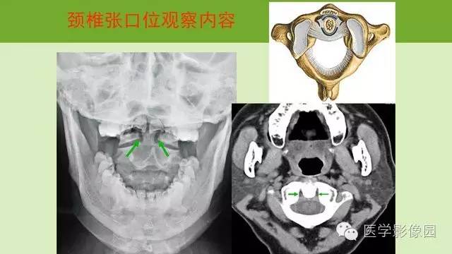 【PPT】颈椎影像阅片方法