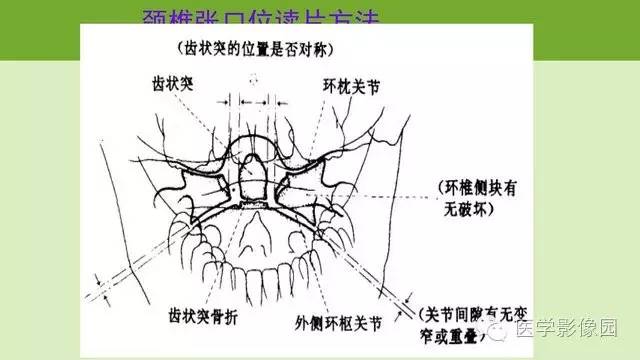 【PPT】颈椎影像阅片方法
