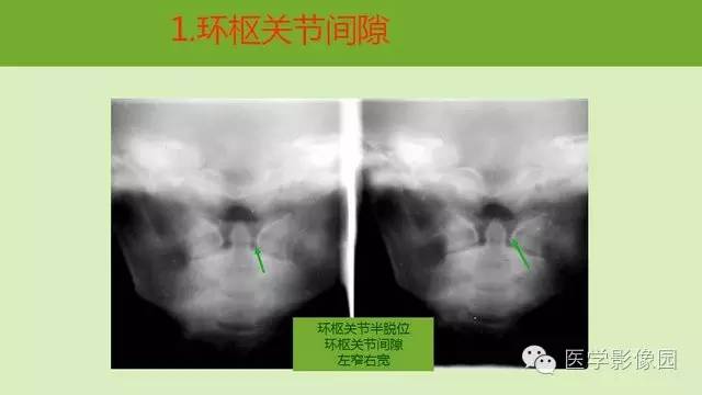 【PPT】颈椎影像阅片方法
