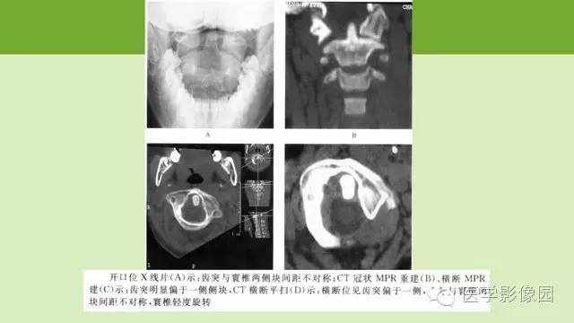 【PPT】颈椎影像阅片方法