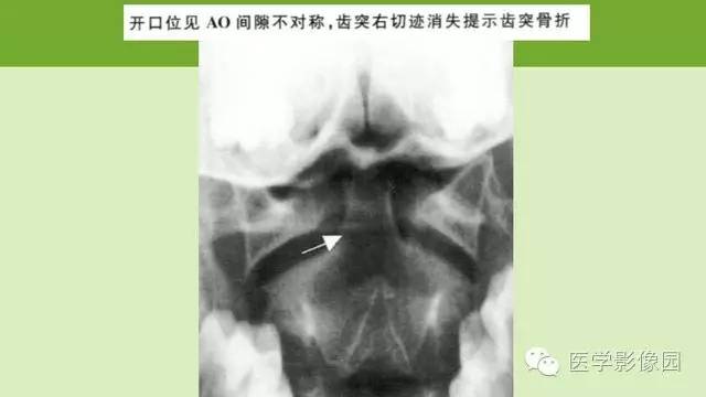 【PPT】颈椎影像阅片方法