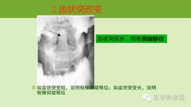 【PPT】颈椎影像阅片方法