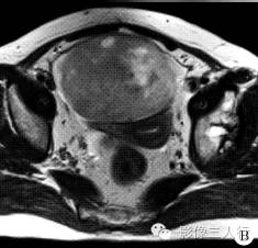 【病例】右卵巢卵泡膜细胞瘤1例MR影像表现 【病例】右卵巢卵泡膜细胞瘤1例MR影像表现