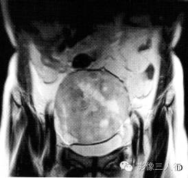 【病例】右卵巢卵泡膜细胞瘤1例MR影像表现 【病例】右卵巢卵泡膜细胞瘤1例MR影像表现