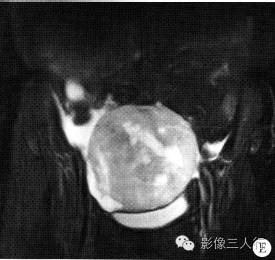 【病例】右卵巢卵泡膜细胞瘤1例MR影像表现 【病例】右卵巢卵泡膜细胞瘤1例MR影像表现