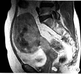 【病例】右卵巢卵泡膜细胞瘤1例MR影像表现 【病例】右卵巢卵泡膜细胞瘤1例MR影像表现