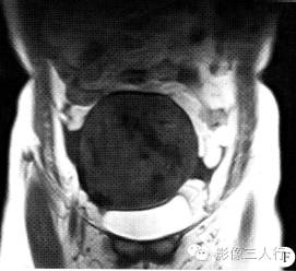 【病例】右卵巢卵泡膜细胞瘤1例MR影像表现 【病例】右卵巢卵泡膜细胞瘤1例MR影像表现