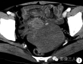 【病例】右卵巢卵泡膜细胞瘤1例MR影像表现 【病例】右卵巢卵泡膜细胞瘤1例MR影像表现