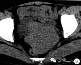 【病例】右卵巢卵泡膜细胞瘤1例MR影像表现 【病例】右卵巢卵泡膜细胞瘤1例MR影像表现