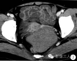【病例】右卵巢卵泡膜细胞瘤1例MR影像表现 【病例】右卵巢卵泡膜细胞瘤1例MR影像表现