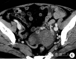 【病例】右卵巢卵泡膜细胞瘤1例MR影像表现 【病例】右卵巢卵泡膜细胞瘤1例MR影像表现
