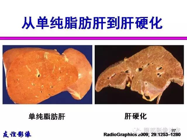 【PPT】脂肪肝CT、MRI定量分析