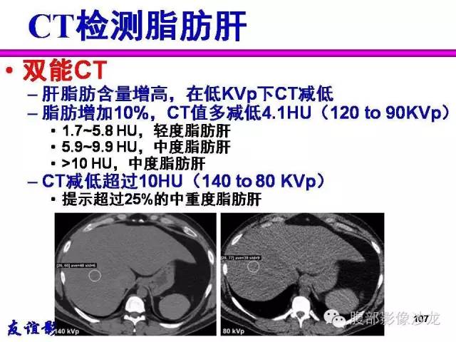 【PPT】脂肪肝CT、MRI定量分析