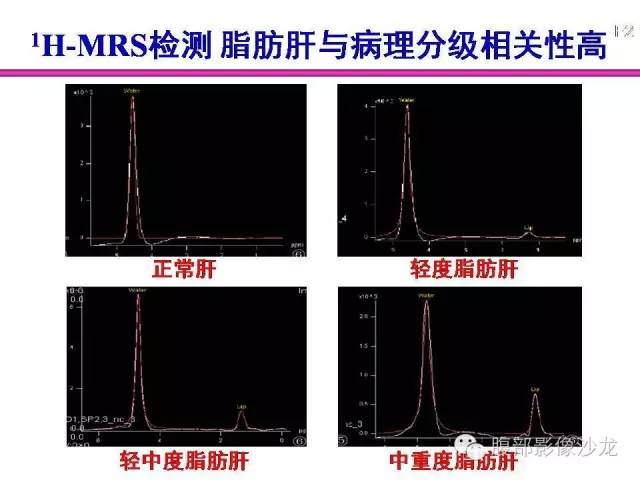 【PPT】脂肪肝CT、MRI定量分析