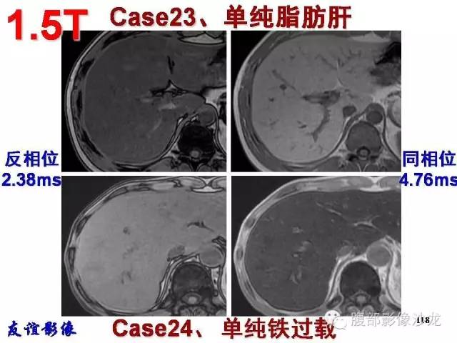 【PPT】脂肪肝CT、MRI定量分析