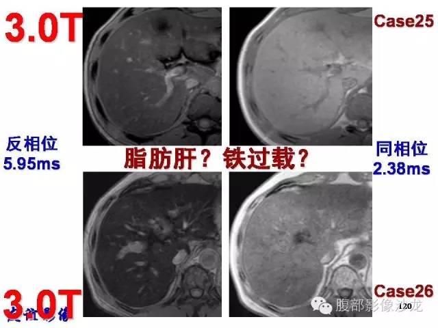 【PPT】脂肪肝CT、MRI定量分析