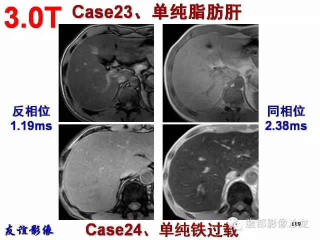 【PPT】脂肪肝CT、MRI定量分析