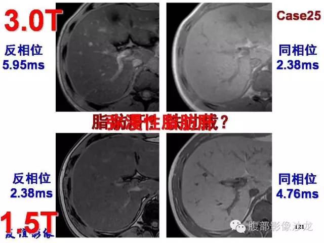 【PPT】脂肪肝CT、MRI定量分析