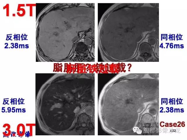 【PPT】脂肪肝CT、MRI定量分析