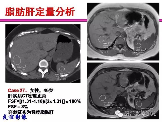 【PPT】脂肪肝CT、MRI定量分析