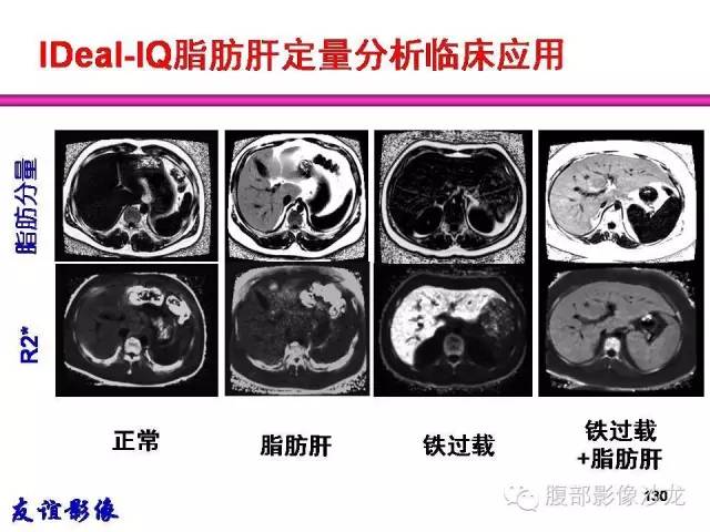 【PPT】脂肪肝CT、MRI定量分析