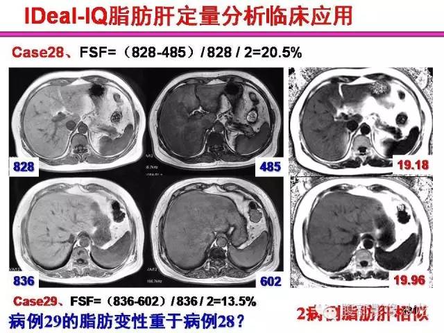 【PPT】脂肪肝CT、MRI定量分析