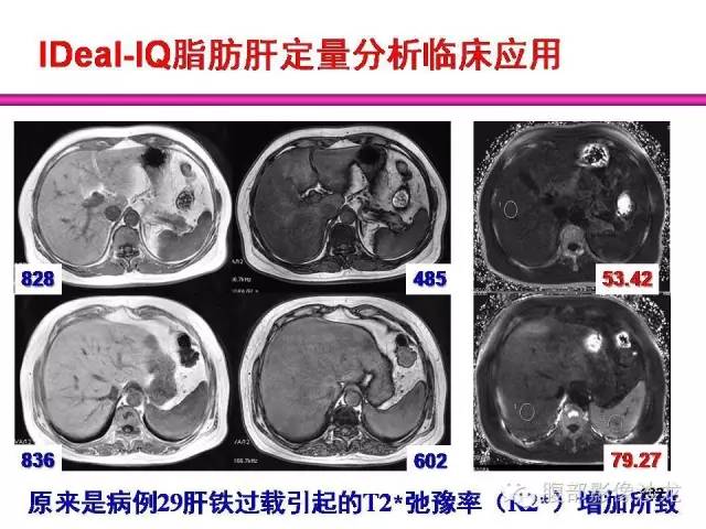 【PPT】脂肪肝CT、MRI定量分析