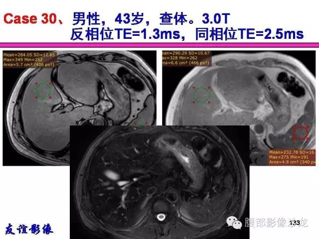 【PPT】脂肪肝CT、MRI定量分析