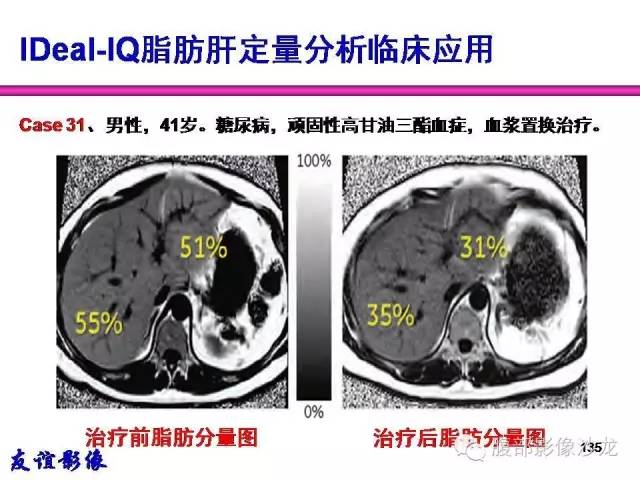 【PPT】脂肪肝CT、MRI定量分析