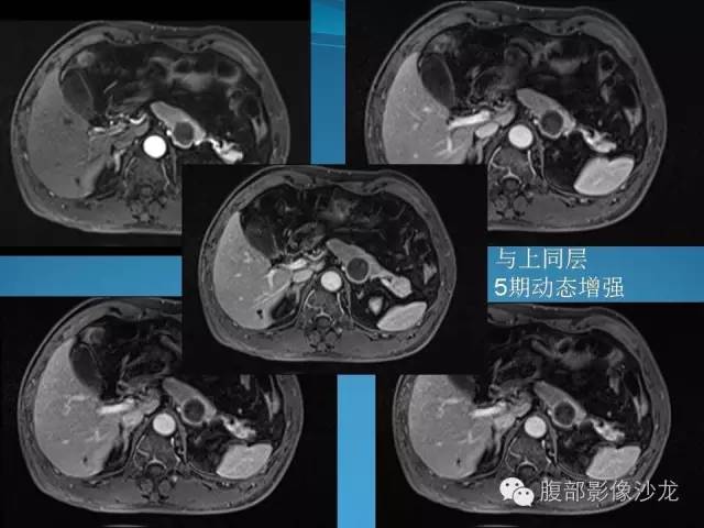 【病例】胰腺神经内分泌肿瘤伴囊变1例MR影像表现 【病例】胰腺神经内分泌肿瘤伴囊变1例MR影像表现