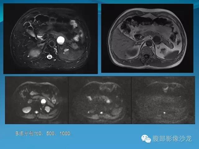 【病例】胰腺神经内分泌肿瘤伴囊变1例MR影像表现 【病例】胰腺神经内分泌肿瘤伴囊变1例MR影像表现
