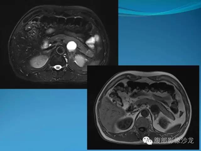 【病例】胰腺神经内分泌肿瘤伴囊变1例MR影像表现 【病例】胰腺神经内分泌肿瘤伴囊变1例MR影像表现