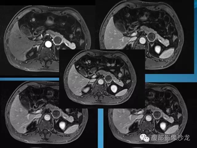 【病例】胰腺神经内分泌肿瘤伴囊变1例MR影像表现 【病例】胰腺神经内分泌肿瘤伴囊变1例MR影像表现