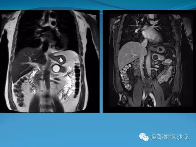 【病例】胰腺神经内分泌肿瘤伴囊变1例MR影像表现 【病例】胰腺神经内分泌肿瘤伴囊变1例MR影像表现