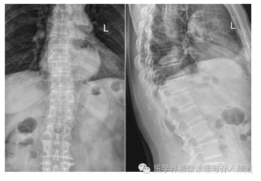 【病例】心影后X线平片易漏诊，你注意到了吗？