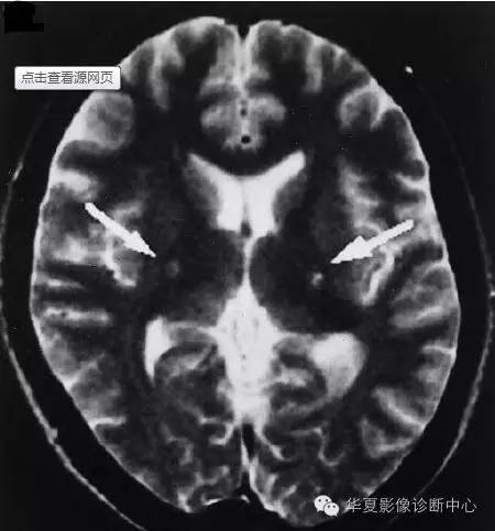 肌萎缩侧索硬化 肌萎缩侧索硬化