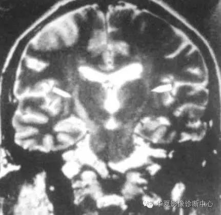 肌萎缩侧索硬化 肌萎缩侧索硬化